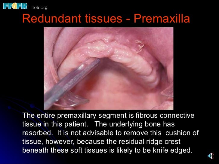 redundant vaginal mucosa Redundant vaginal mucosa